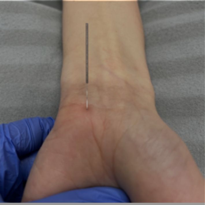 dry-needling-2