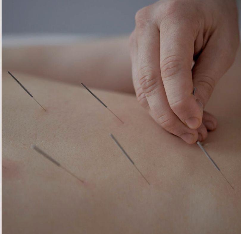 dry-needling-1