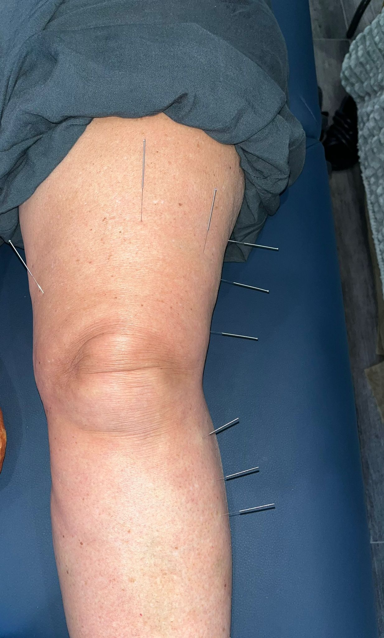 Dry Needling the Whole Leg