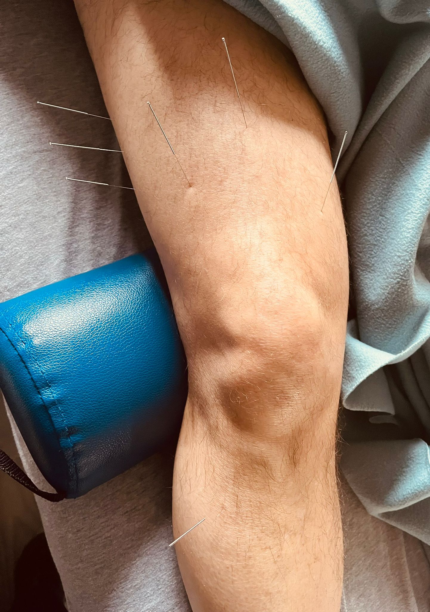 Dry Needling The Thigh