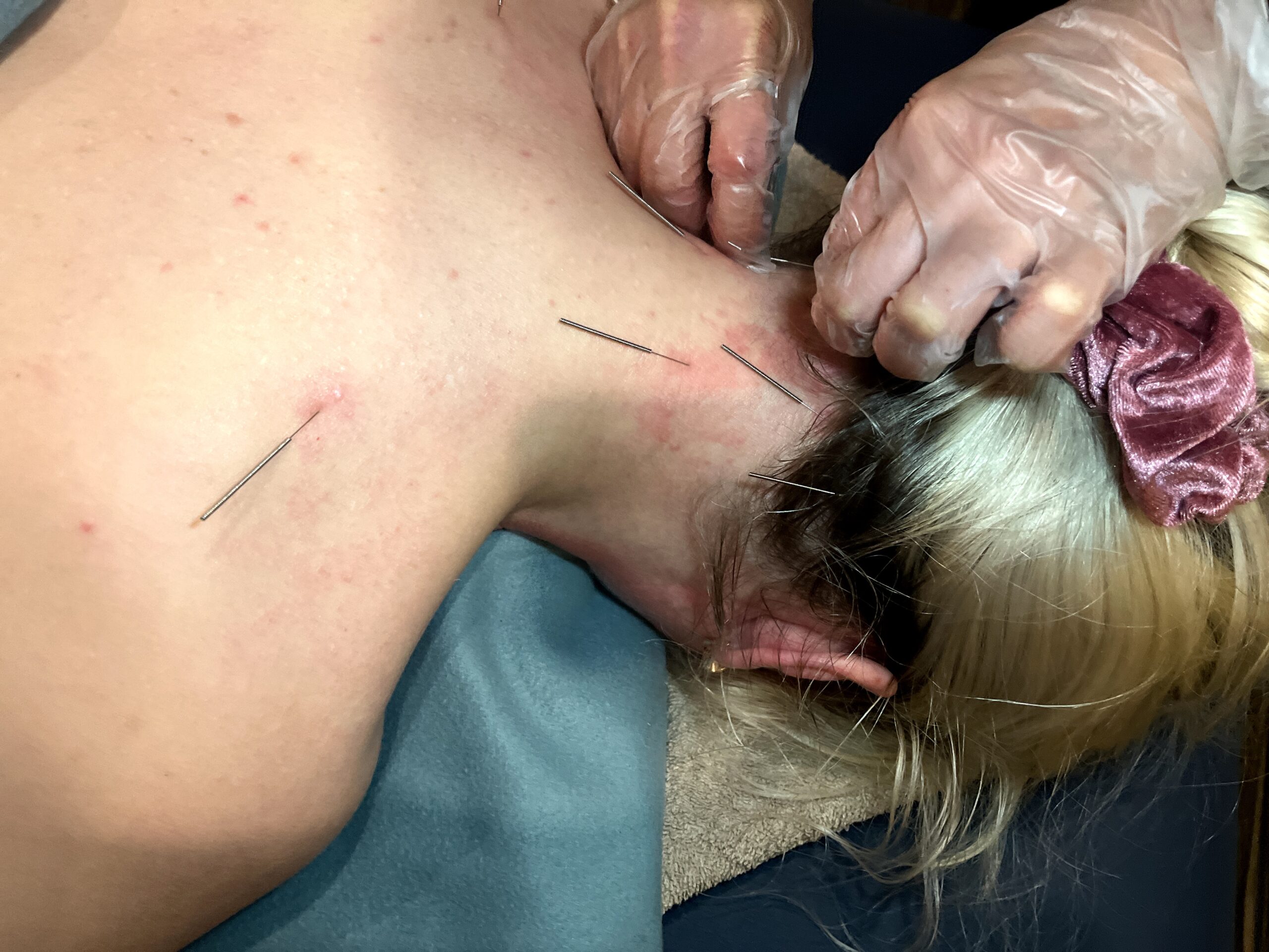 Neck Dry Needling